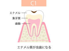 C1【エナメル質のむし歯】