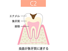 C2【象牙質のむし歯】