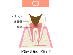 C3【神経のむし歯】